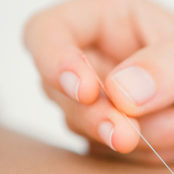 An acupuncture practitioners hand inserting an acupuncture needle into a patient